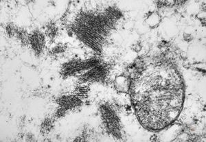 F,55y. | leiomyosarcoma - omentum F,55y. | leiomyosarcoma - omentum